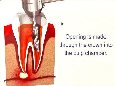 Access Cavity Preparation