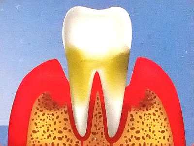 Problem: 
Advanced Periodontitis - Exposed Root & Bone Destruction
