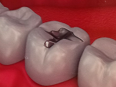 Amalgum Fillings