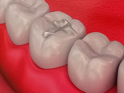 Composite Fillings