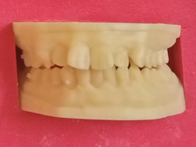 Crooked Teeth