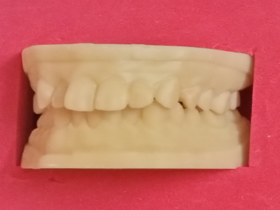 Cross Bite