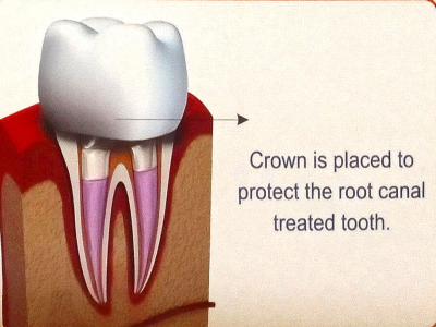 Crown Replacement