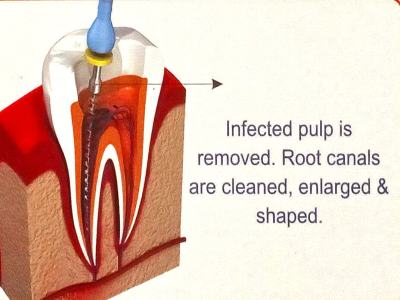 Exterpation & Debridement