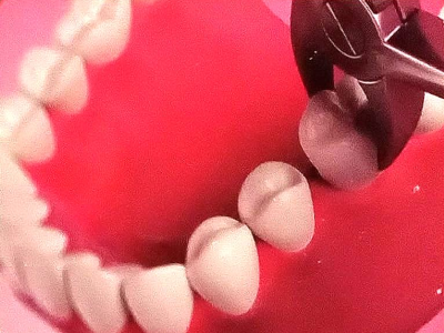 Solution: 
Extraction - Removal of Tooth