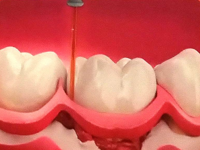 Solution: 
Gingival Flap Surgery - Eliminates Pockets & Prevents Bone Loss