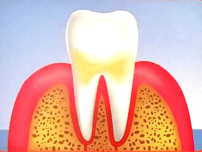 Problem: 
Gingivitis - Inflamed Gum