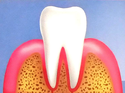 Problem: 
Healthy Gingiva -
Fibers Holding Gum To Bone