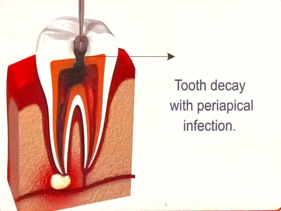 Infected Tooth