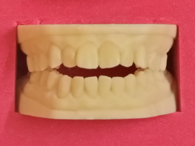 Open bite