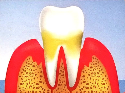 Problem: 
Periodontitis - Pocket Formation & Bone Destruction