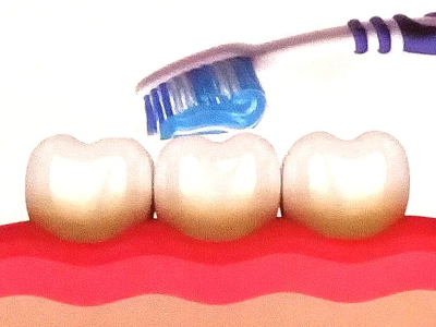 Solution: 
Tooth Brushing - Removes soft Deposits & freshens mouth