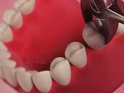 Extractions