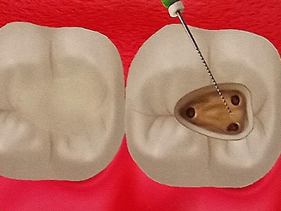 Root Canal Treatment